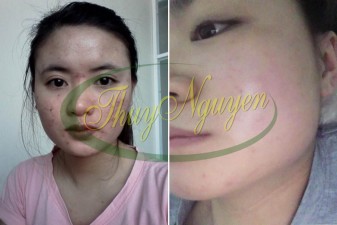 Liệu Trình Điều Trị Mụn Cám - Mụn Li Ti - Mụn Ẩn Dưới Da - Mụn Thâm Cho MSKH 50106